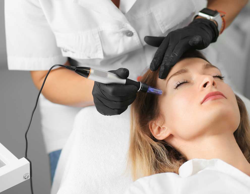 Microneedling Service at Dina's Hair Vogue in west Vancouver